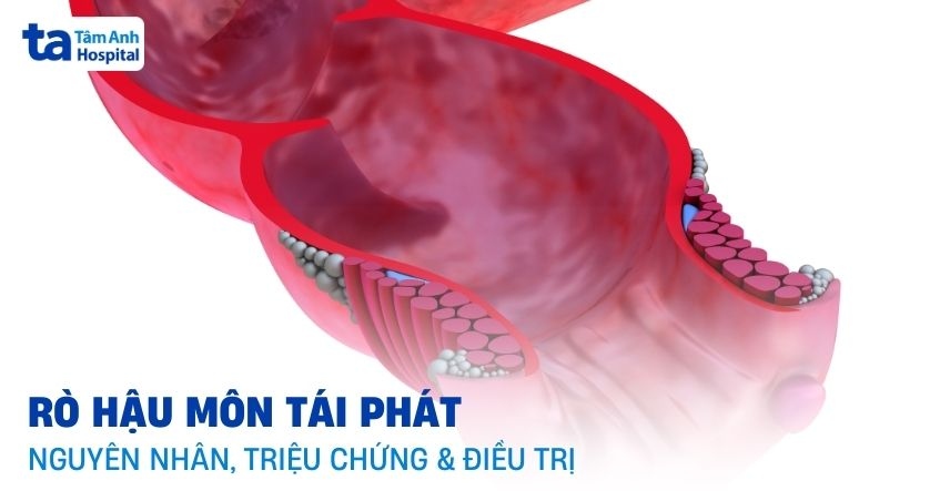 Rò hậu môn tái phát: Nguyên nhân, dấu hiệu, điều trị và phòng ngừa