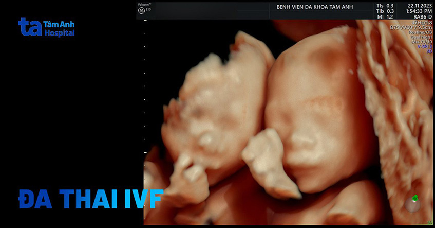 Rủi ro đa thai khi thụ tinh ống nghiệm