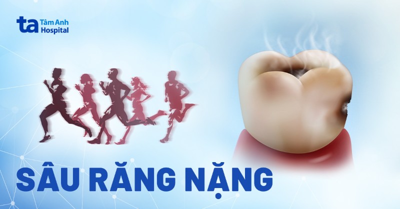 Sâu răng nặng: Dấu hiệu, nguyên nhân và cách điều trị