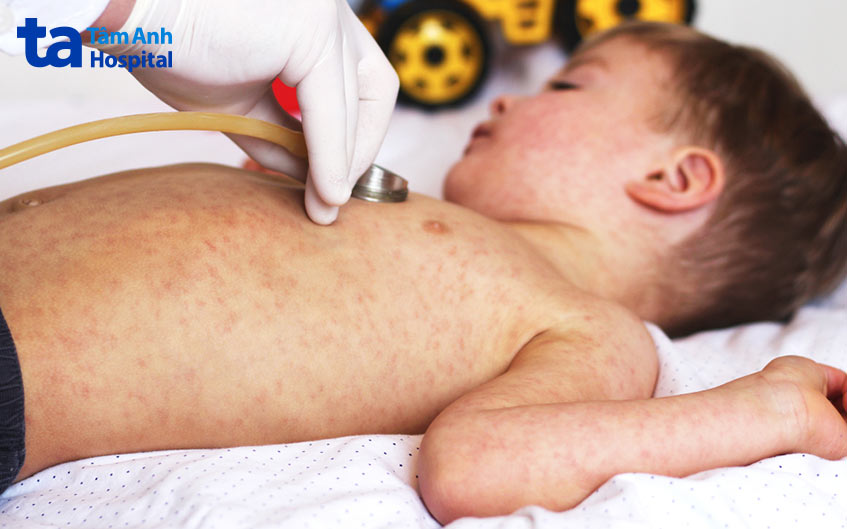 Sởi dẫn đến viêm phổi tổn thương não nhiễm trùng tai