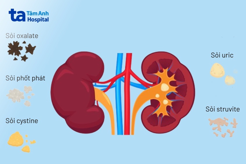 sỏi đường tiết niệu thường gặp