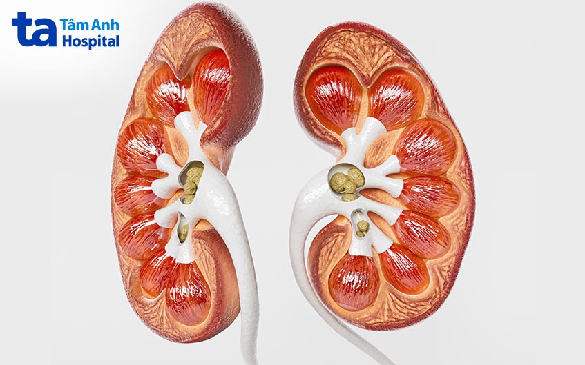 sỏi thận có nguy cơ cao mắc gút