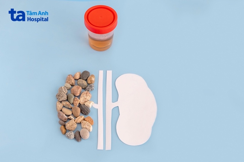 sỏi tiết niệu là bệnh gì