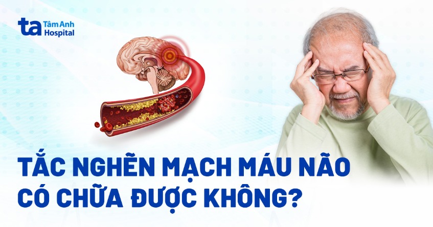 Tắc nghẽn mạch máu não có chữa được không? Yếu tố nào ảnh hưởng?