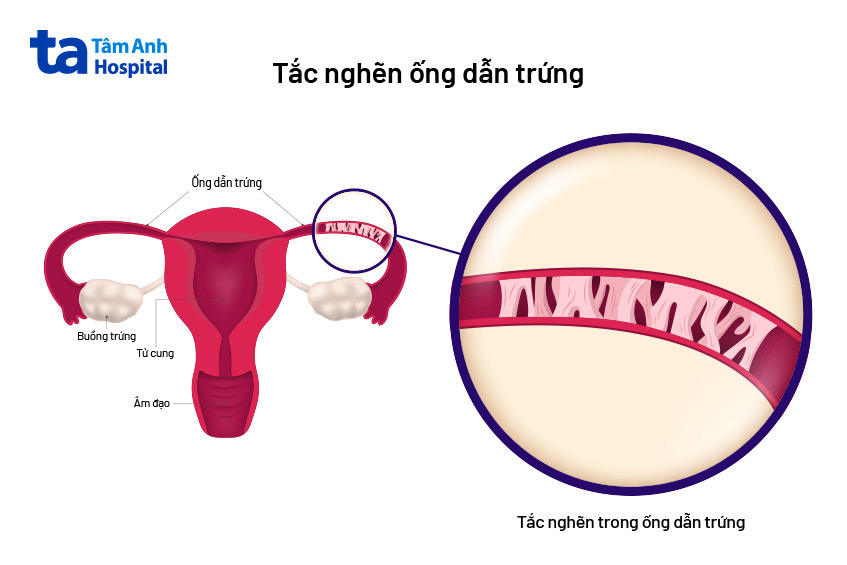 Tắc nghẽn ống dẫn trứng do viêm nhiễm, nhiễm trùng