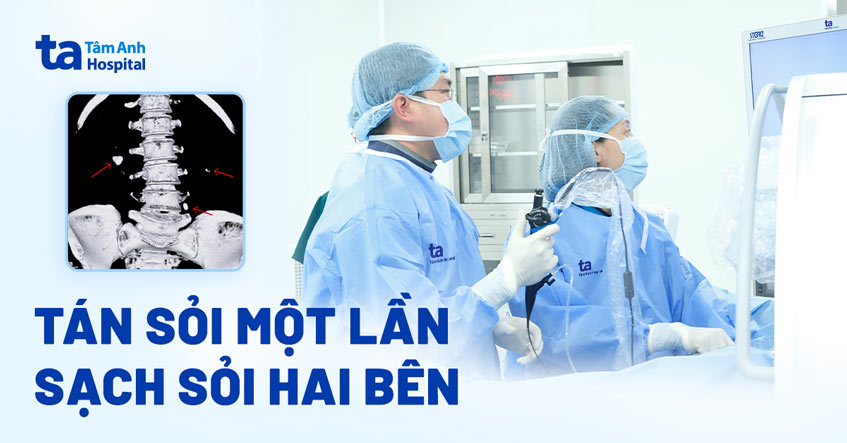 Tán sỏi một lần sạch sỏi hai bên