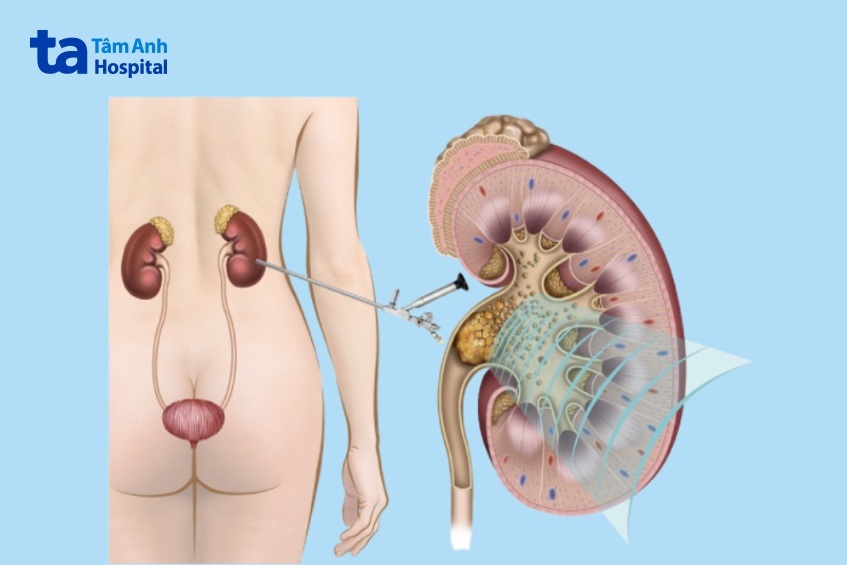 tán sỏi qua da là phương pháp điều trị hiệu quả