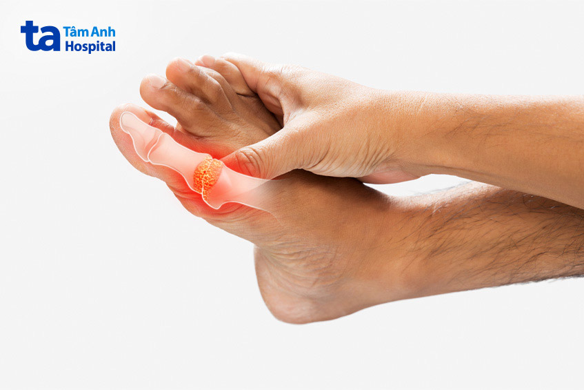 Tăng acid uric máu tiền đề bệnh gout