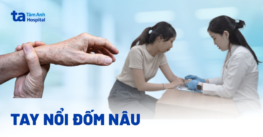 Tay nổi đốm nâu nguyên nhân vì sao? Dấu hiệu và cách phòng ngừa