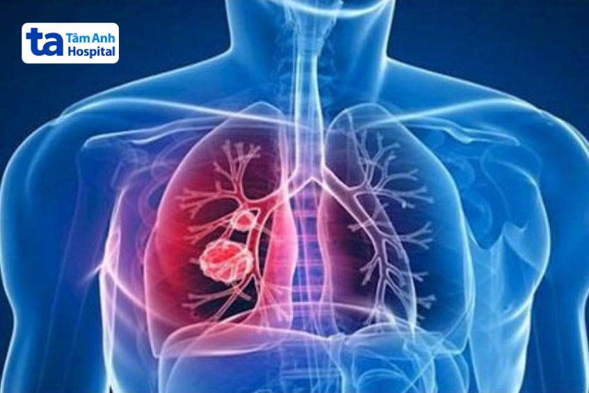 tế bào ung thư di căn từ phổi tới hạch trung thất