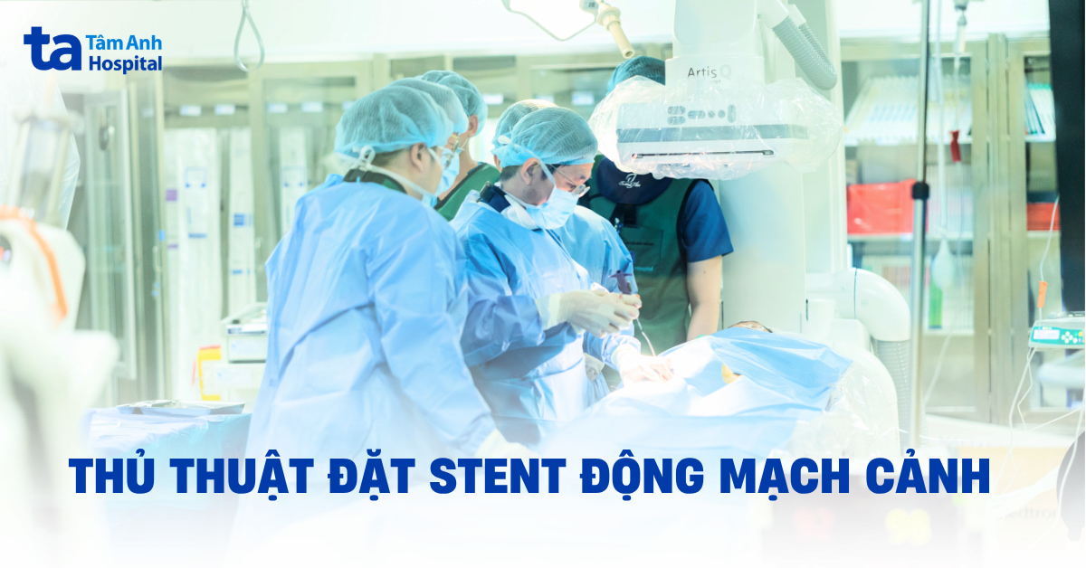 Đặt stent động mạch cảnh: Quy trình, chỉ định và chống chỉ định