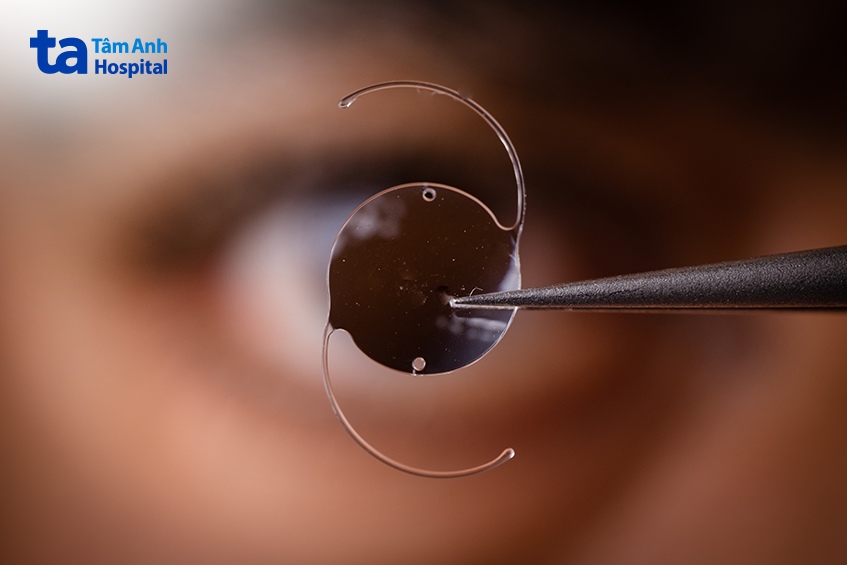 thuỷ tinh thể đơn tiêu điểm loại nào tốt nhất