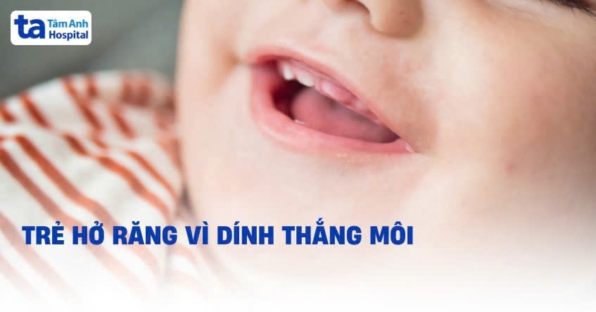 Trẻ hở răng vì dính thắng môi