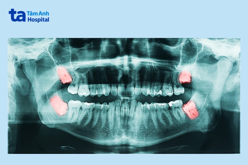 Răng khôn hàm trên mọc khi nào?