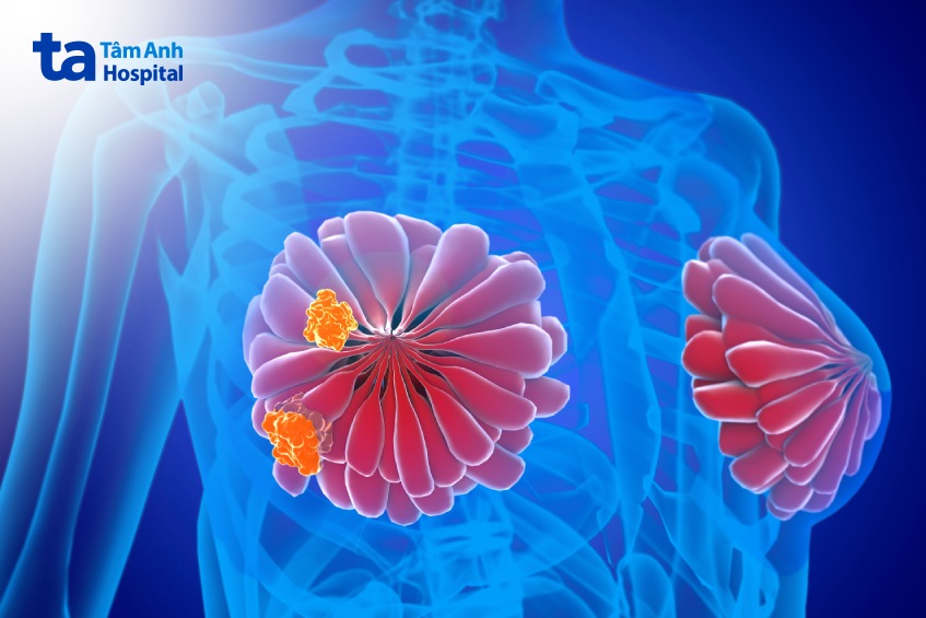 triệu chứng ung thư vú di căn gan