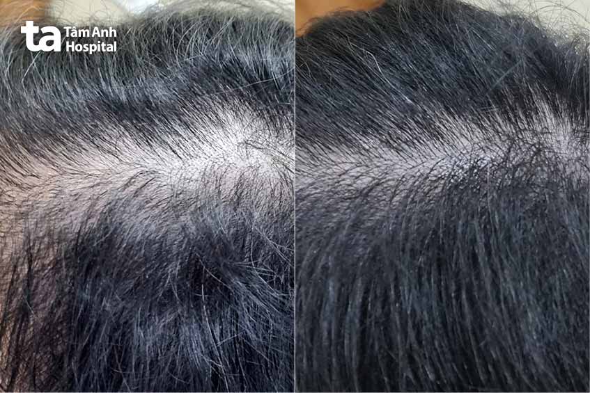 Trước và sau 3 tháng điều trị tại bệnh viện tâm anh