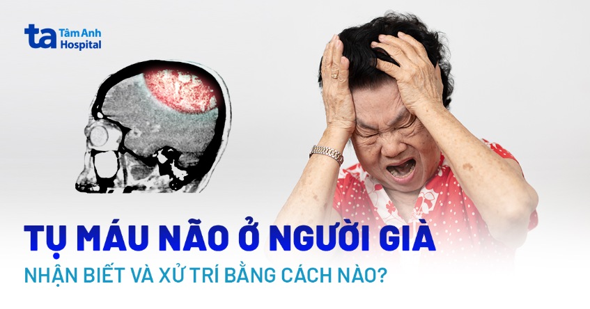 Tụ máu não ở người già: Dấu hiệu, nguyên nhân, chẩn đoán và điều trị