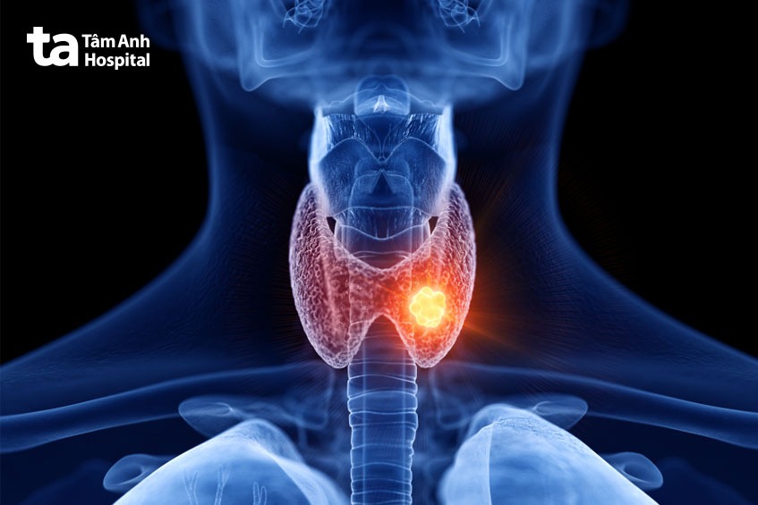U nang tuyến giáp là bệnh tiến triển âm thầm, khó phát hiện