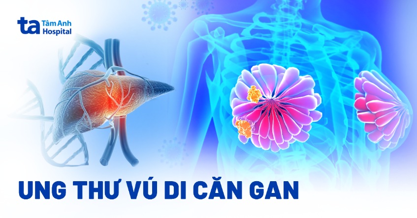 ung thư vú di căn gan
