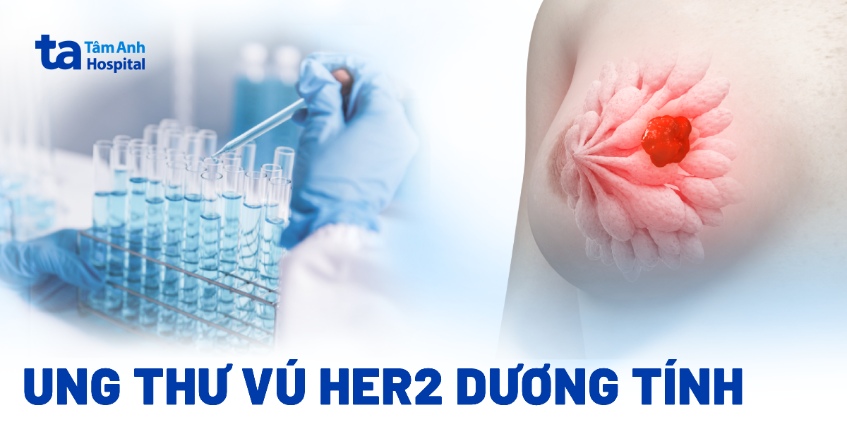 Ung thư vú HER2 dương tính có nguy hiểm không? Dấu hiệu và chẩn đoán