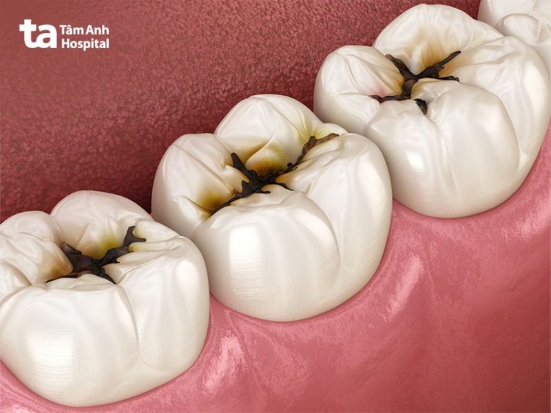 Một số vấn đề thường gặp ở răng số 6