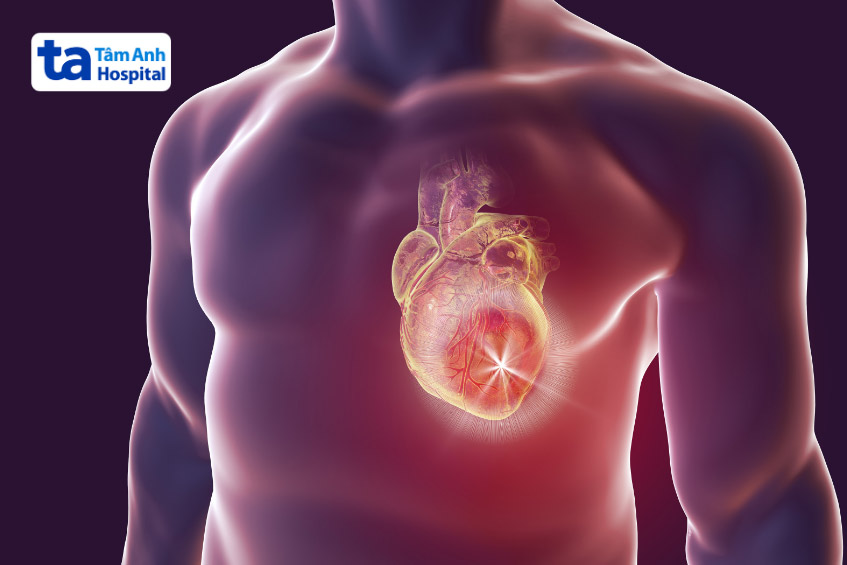 Viêm cơ tim nặng có thể dẫn đến rối loạn nhịp tim, suy tim, gây tử vong