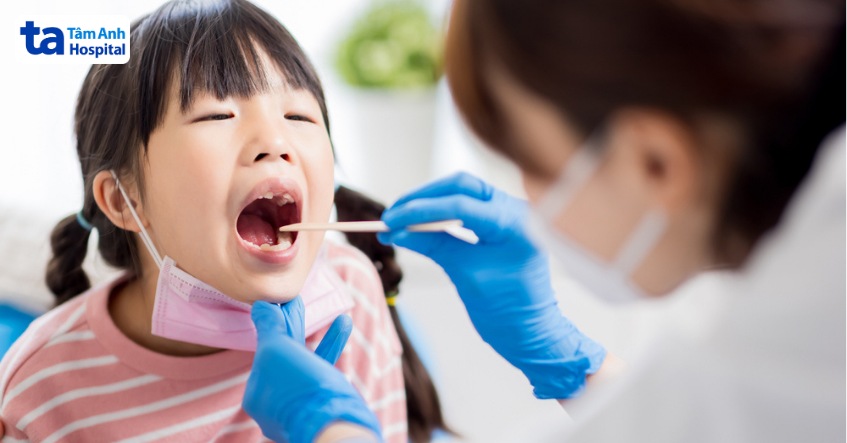 viêm họng liên cầu khuẩn