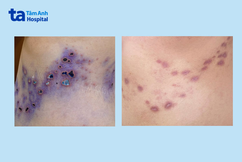 Vùng hông trước và sau khi điều trị zona