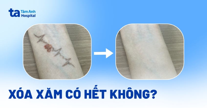 Xóa xăm có hết không? Điều gì ảnh hưởng đến kết quả triệt để?