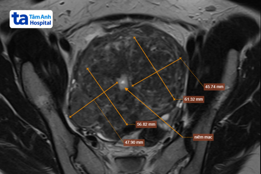 Ảnh chụp cộng hưởng từ u xơ tử cung