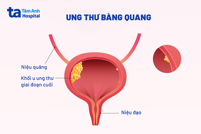 Ảnh minh họa ung thư bàng quang