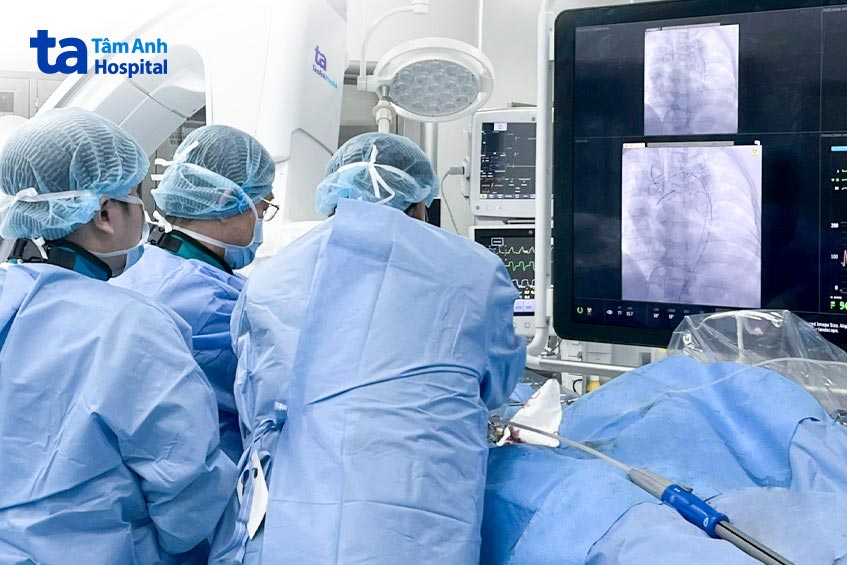 Các bác sĩ can thiệp đặt covered stent cho một trường hợp phình động mạch chủ