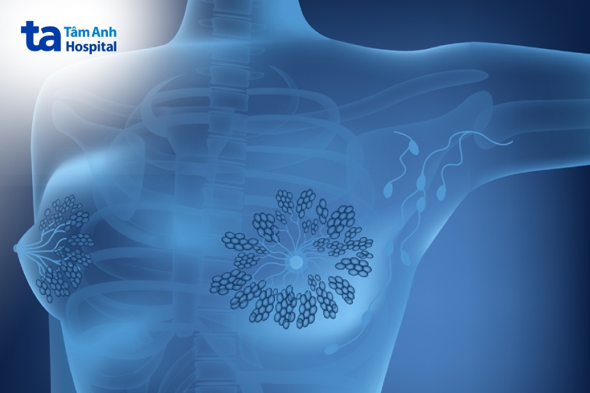 bảo tồn vú có tạo hình có nguy hiểm không