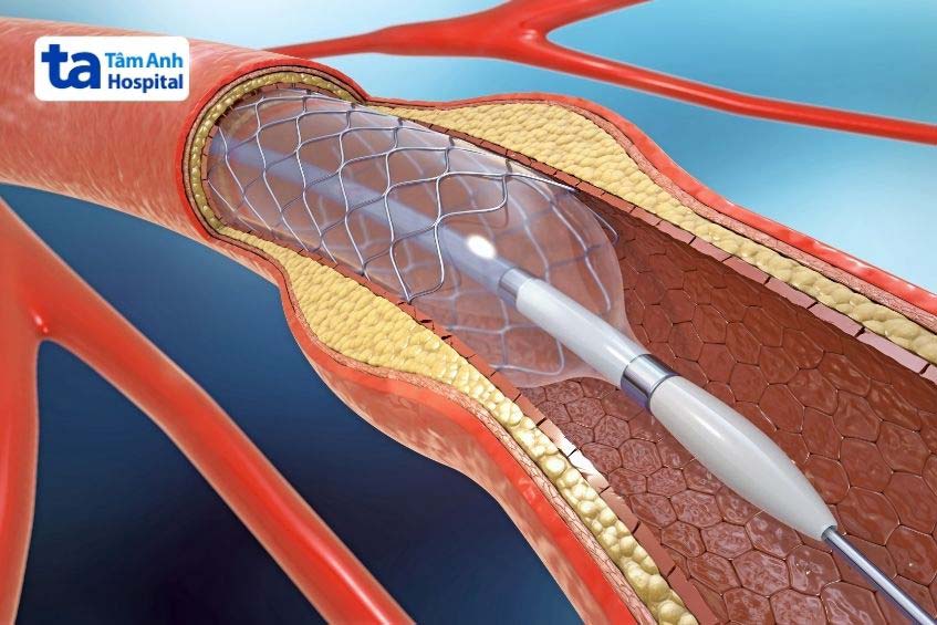 Bệnh nhân nhồi máu cơ tim phải đặt stent để điều trị