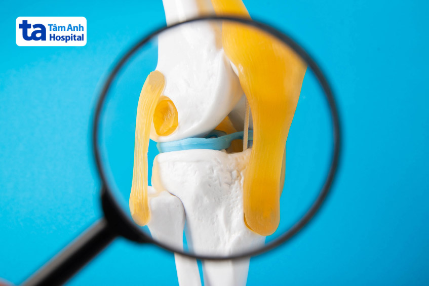 bệnh still trẻ em bắt đầu bằng viêm bao hoạt dịch