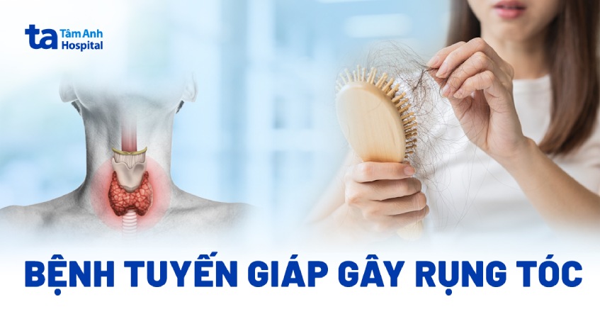 Bệnh tuyến giáp gây rụng tóc nguyên nhân do đâu? Dấu hiệu là gì?