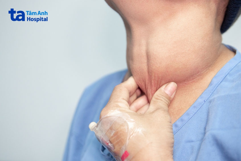 Bướu giáp to ra chèn ép các cơ quan xung quanh