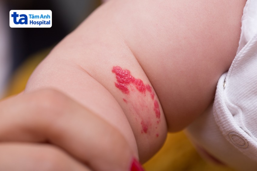 Bướu máu có thể xuất hiện ở bất kỳ trẻ nào