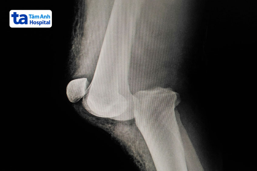 các dấu hiệu khớp gối bị trật