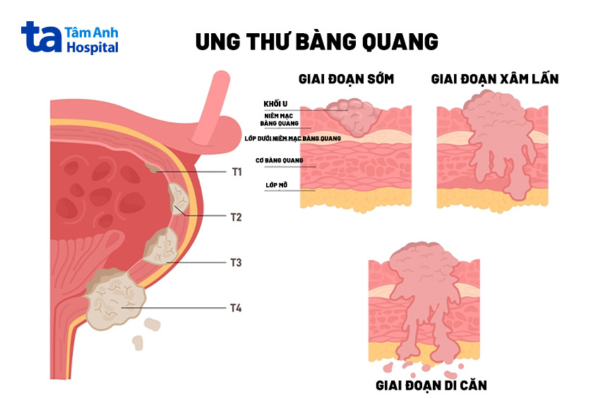 các giai đoạn ung thư bàng quang