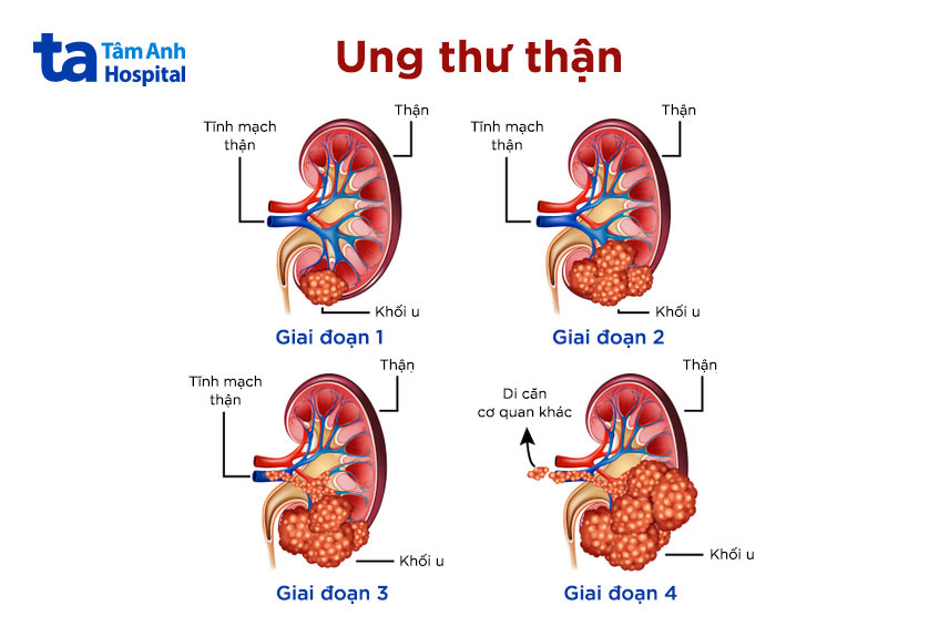 các giai đoạn ung thư thận