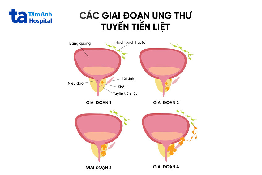 Các giai đoạn ung thư tuyến tiền liệt