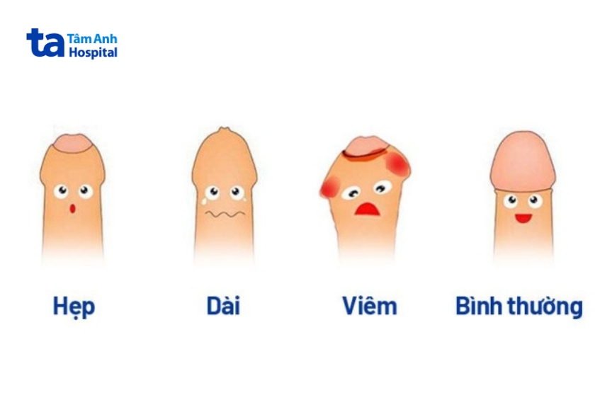 Các mức độ hẹp bao quy đầu