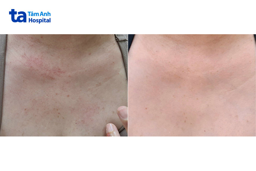 các nốt sẩn ngứa trước và sau khi điều trị