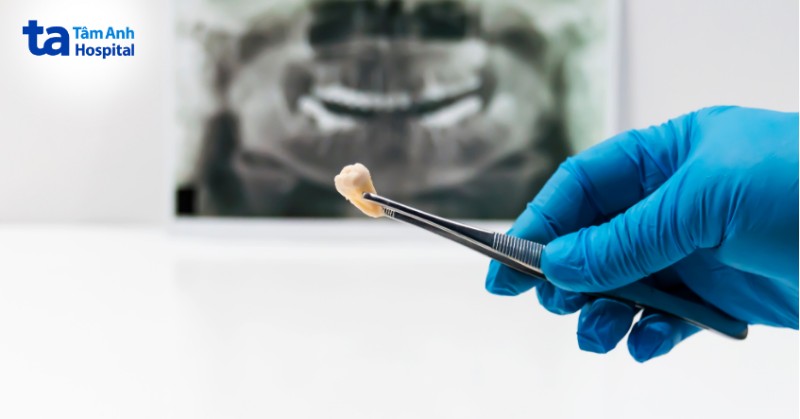 Tầm quan trọng của việc chăm sóc sau nhổ răng đúng cách