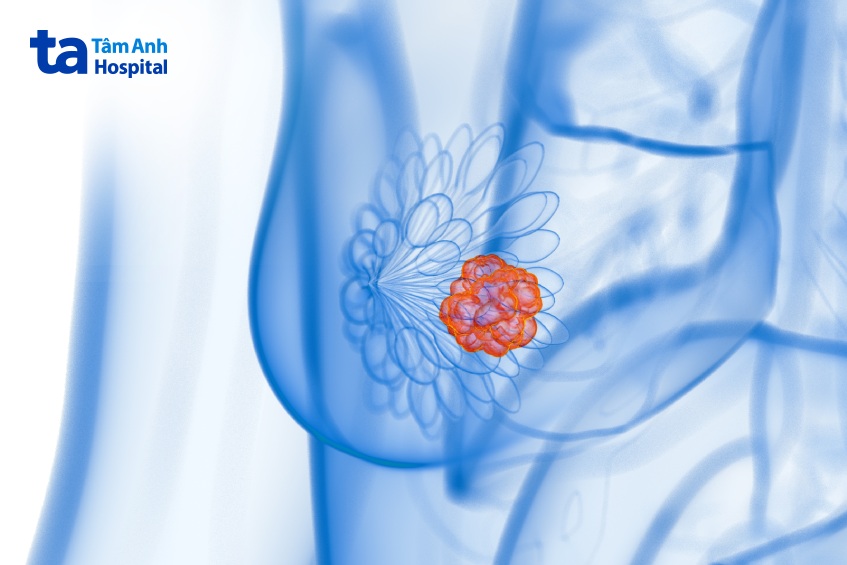 căng thẳng có làm tăng nguy cơ ung thư vú