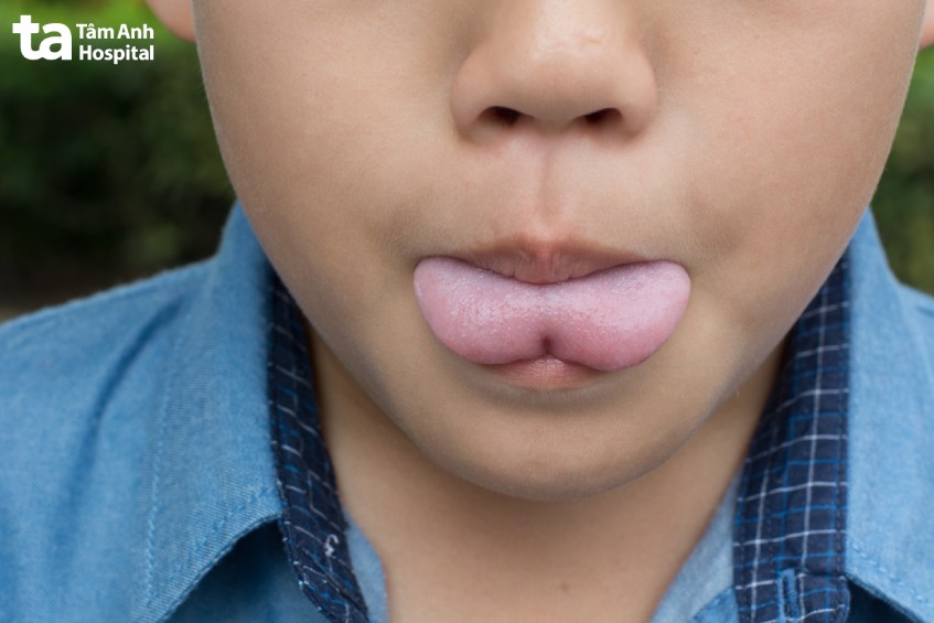 cắt dính thắng lưỡi có nguy hiểm không