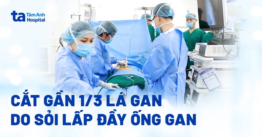 Nhiễm trùng đường mật do sỏi bịt kín ống gan