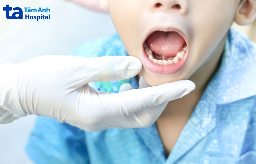 cắt thắng lưỡi cho bé có đau không