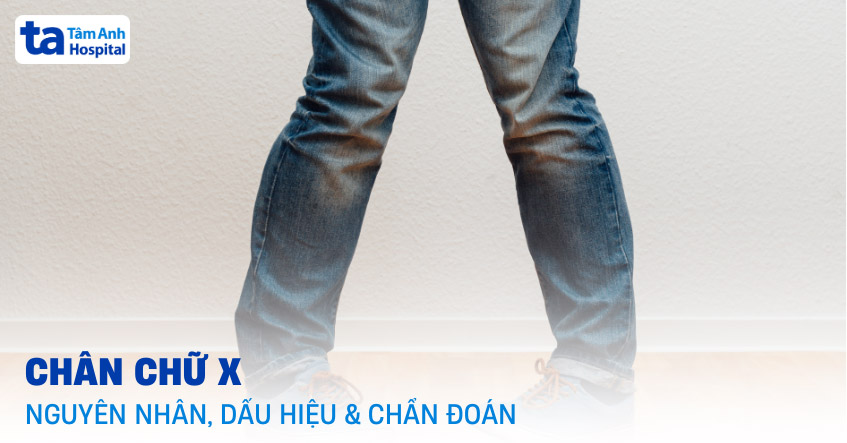 chân chữ x